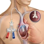 Hemodialysis Catheter3